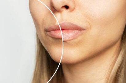 Cómo cuidarse tras un aumento de labios