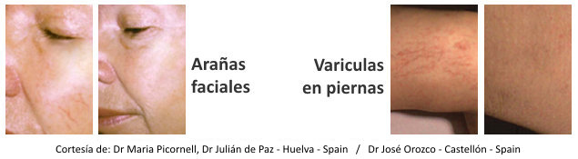 Eliminación de arañas vasculares faciales y en piernas