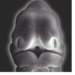 Tratamientos Rinoplastia - Cara embrión