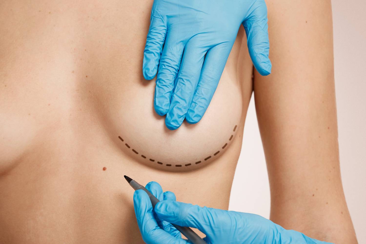 Desplazamiento implantes de pecho - Centro Europeo de Cirugía Estética