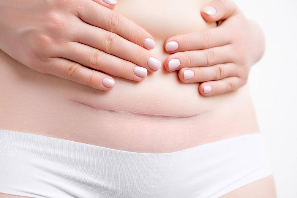 Corrección abdomen postparto y cesárea - Centro Europeo de Cirugía Estética