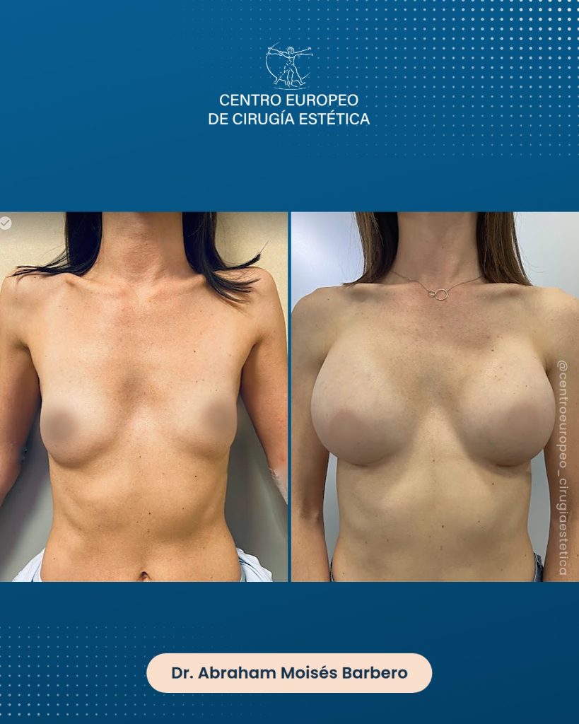 Aumento de pecho, caso 01 — Comparativa