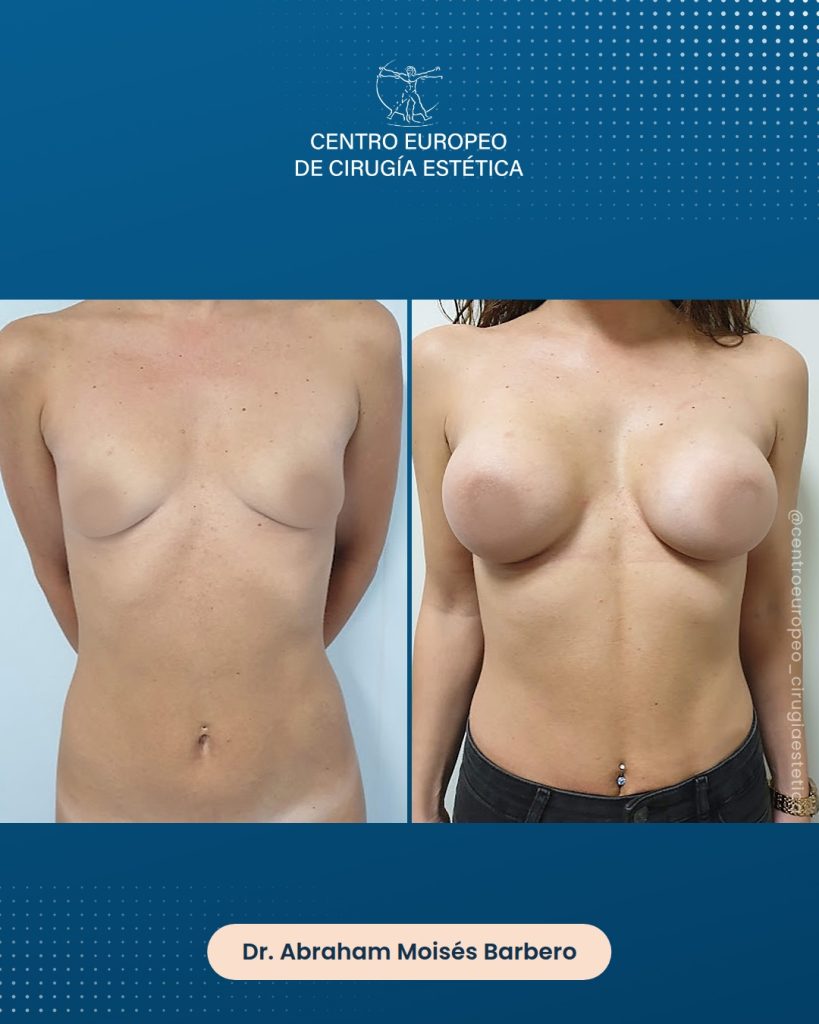 Aumento de pecho, caso 02 — Comparativa