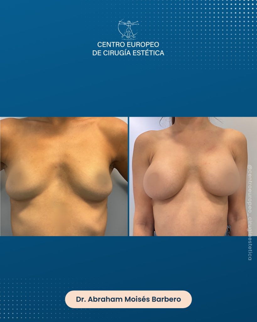 Aumento de pecho, caso 03 — Frontal