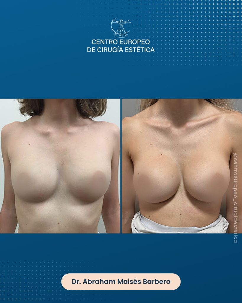 Aumento de pecho, caso 05 — Frontal