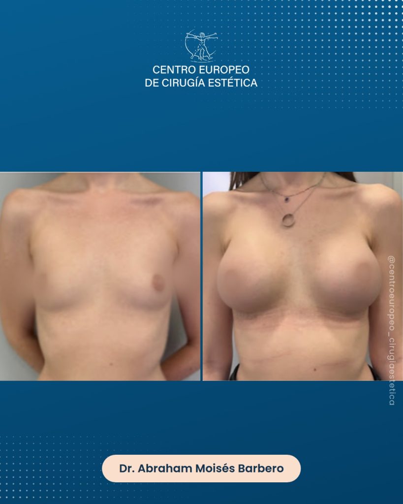 Aumento de pecho, caso 06 — Frontal