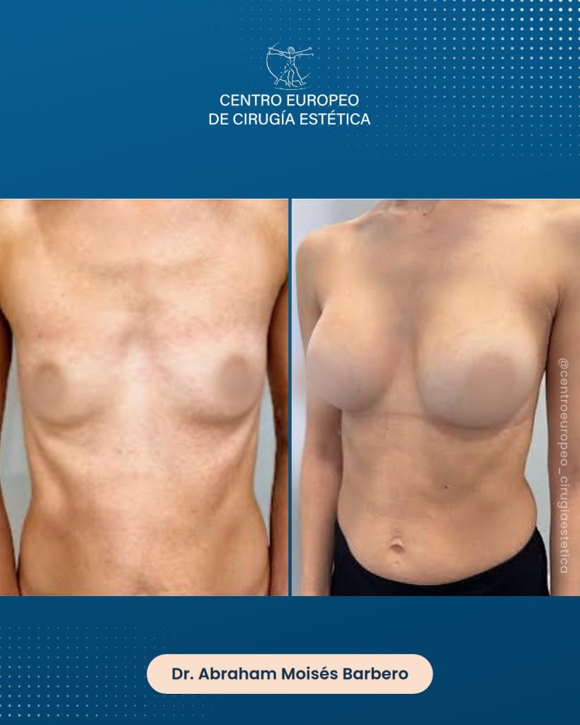 Aumento de pecho, caso 07 — Frontal