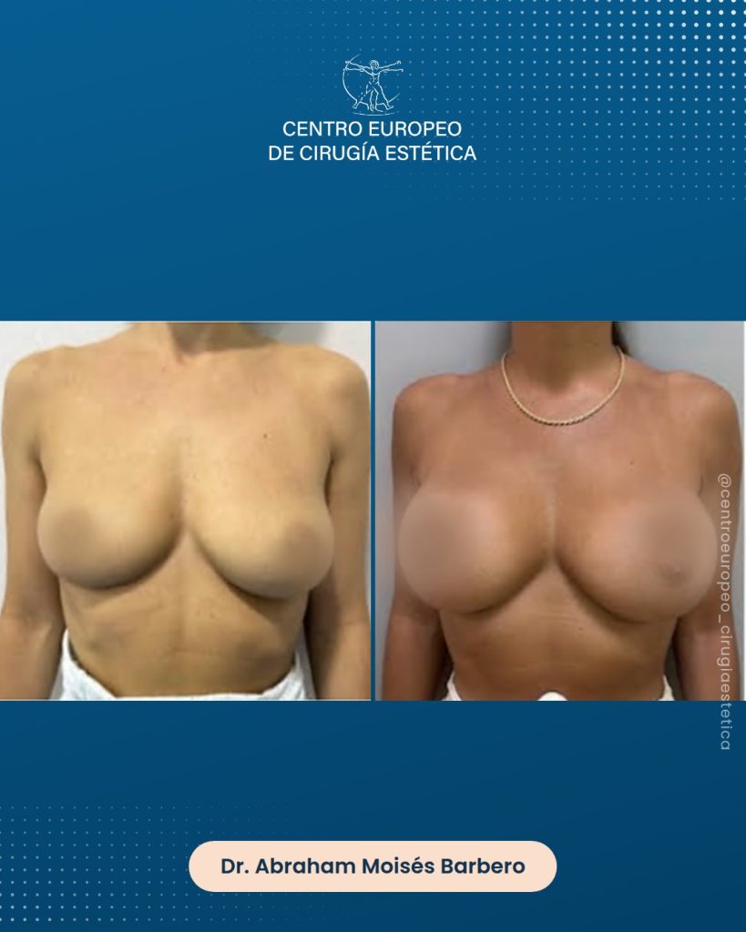 Aumento de pecho, caso 08 — Frontal