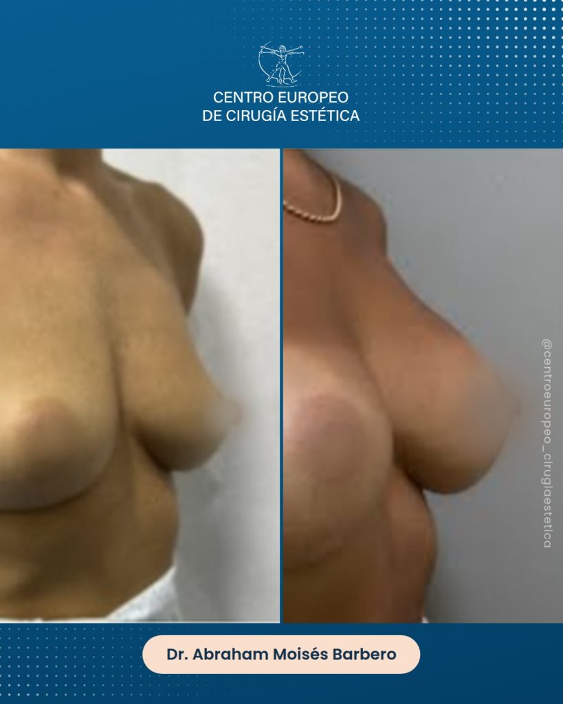 Aumento de pecho, caso 08 — Tres cuartos derecha