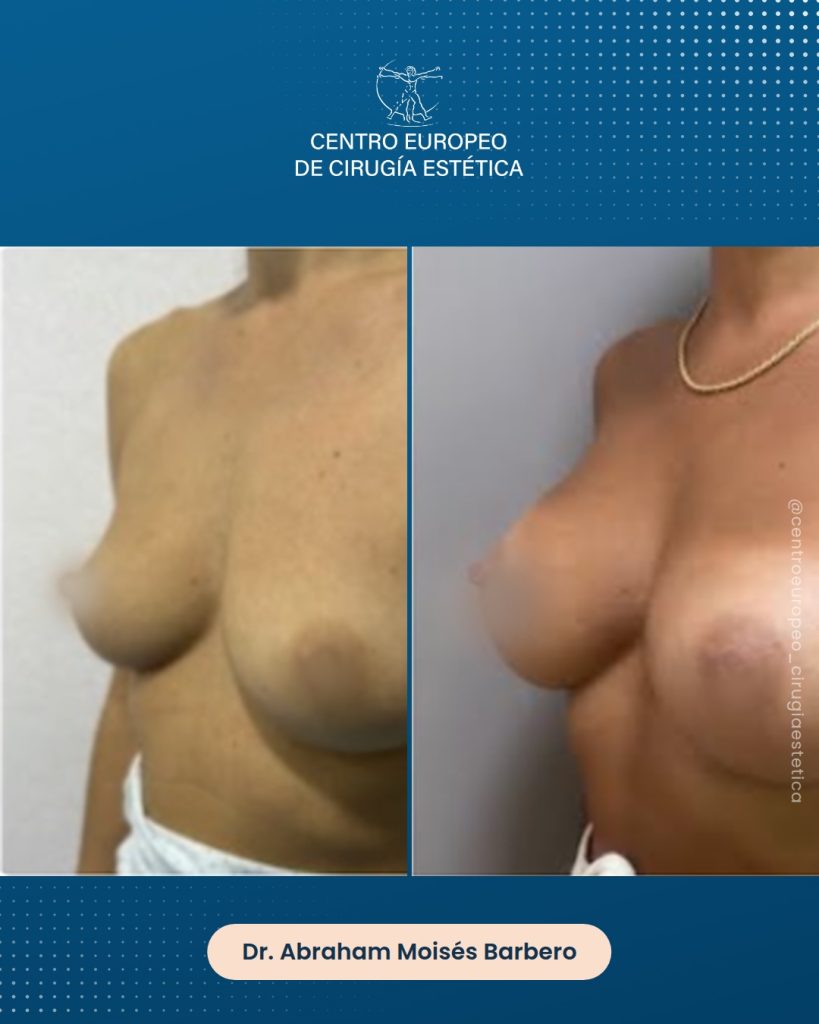 Aumento de pecho, caso 08 — Tres cuartos izquierda