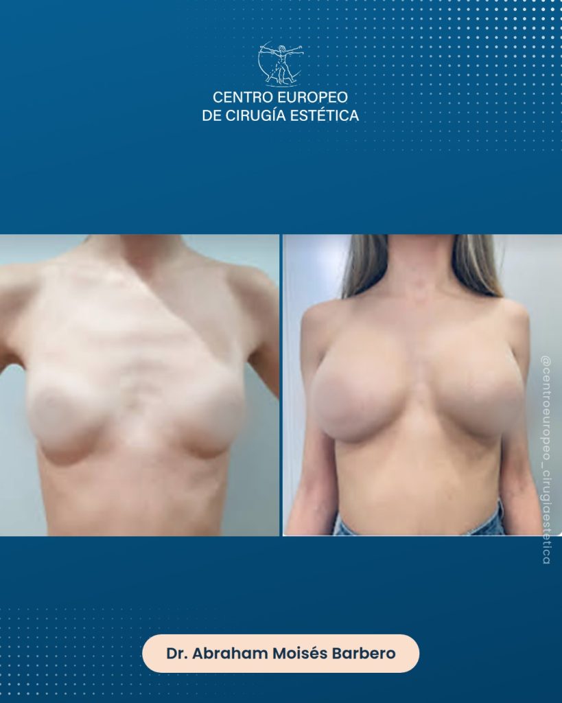 Aumento de pecho, caso 09 — Frontal