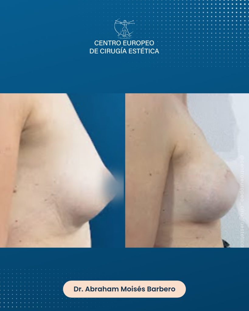 Aumento de pecho, caso 10 — Perfil derecho