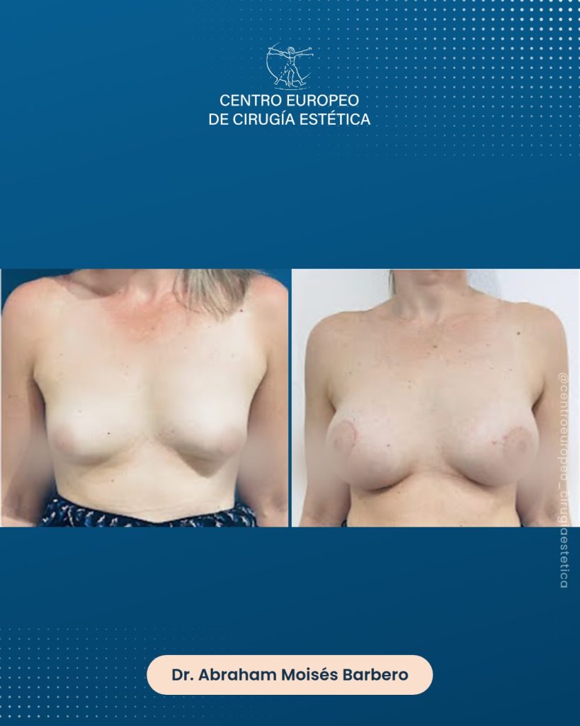 Aumento de pecho, caso 10 — Frontal