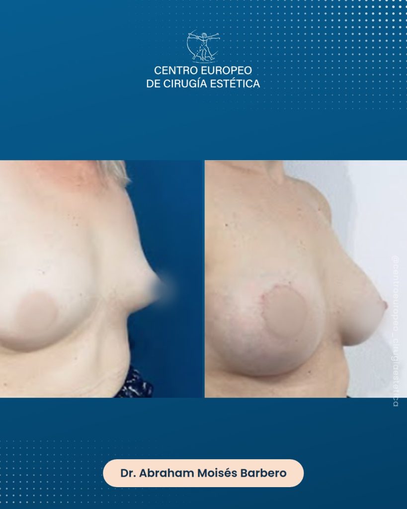 Aumento de pecho, caso 10 — Tres cuartos derecha