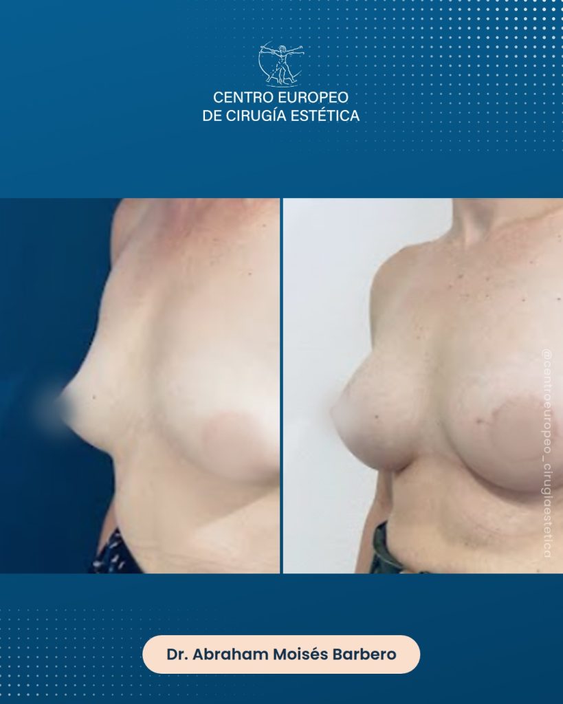 Aumento de pecho, caso 10 — Tres cuartos izquierda