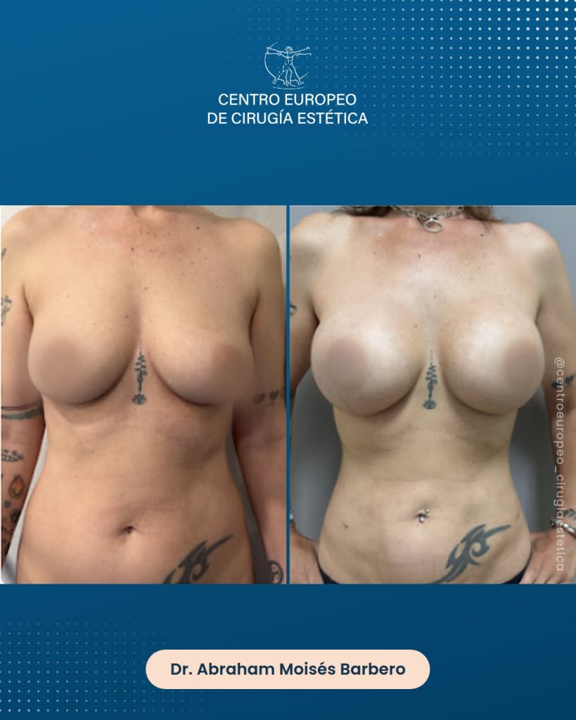 Aumento de pecho, caso 11 — Frontal