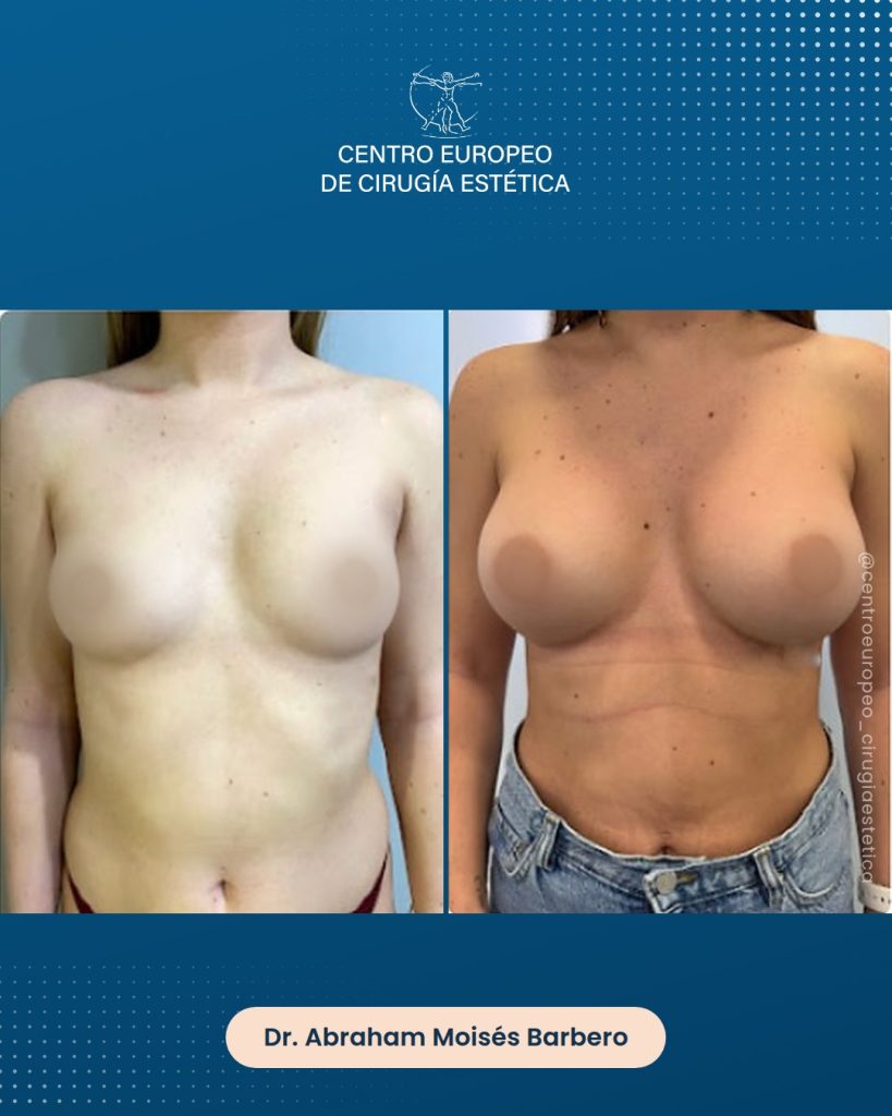 Aumento de pecho, caso 12 — Frontal