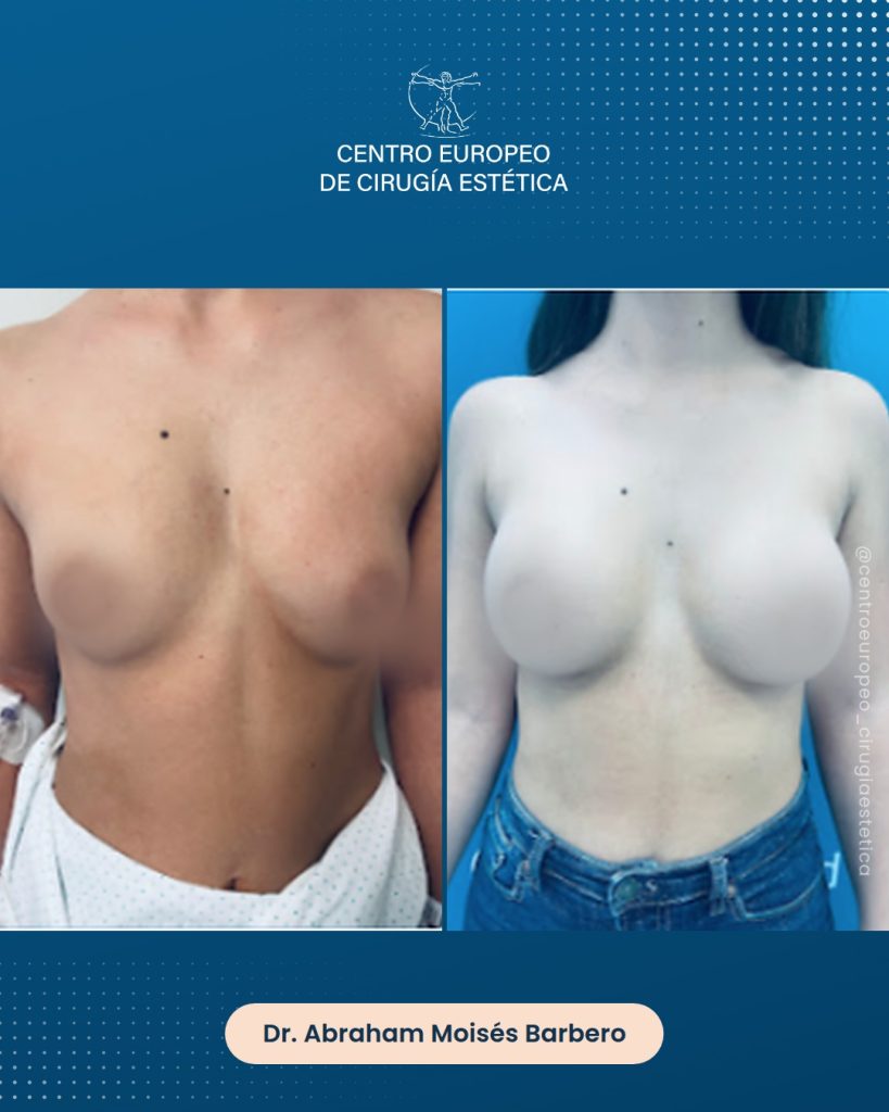 Aumento de pecho, caso 13 — Frontal