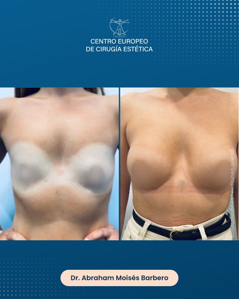 Aumento de pecho, caso 14 — Frontal
