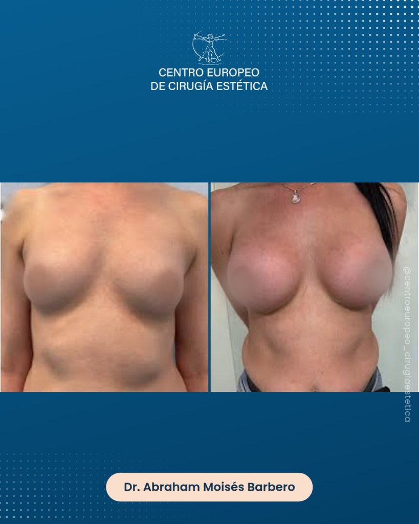 Aumento de pecho, caso 15 — Frontal