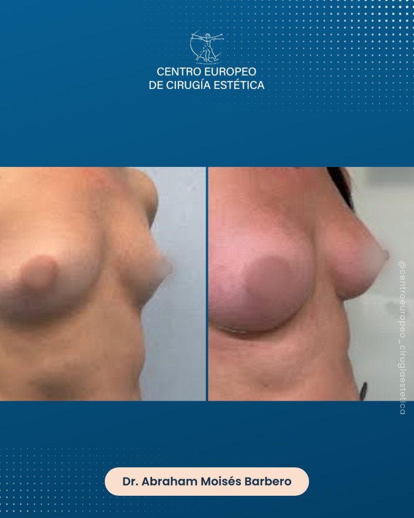 Aumento de pecho, caso 15 — Tres cuartos derecha