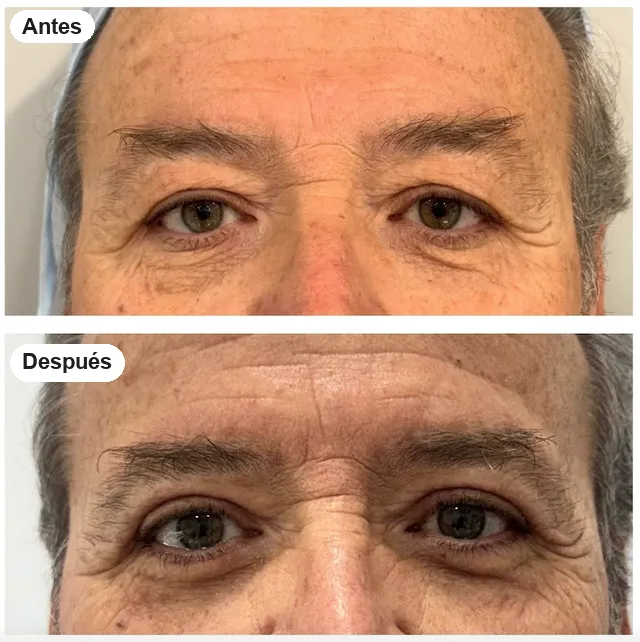 Antes y después de blefaroplastia en Granada, caso 1
