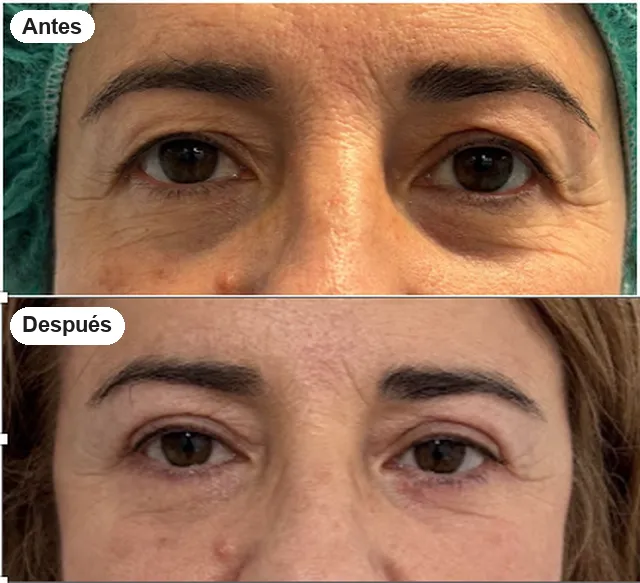 Antes y después de blefaroplastia en Granada, caso 2