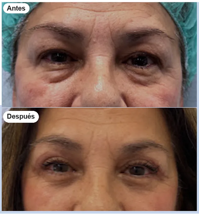 Antes y después de blefaroplastia en Granada, caso 4