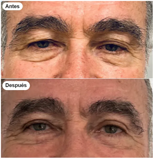 Antes y después de blefaroplastia en Granada, caso 5