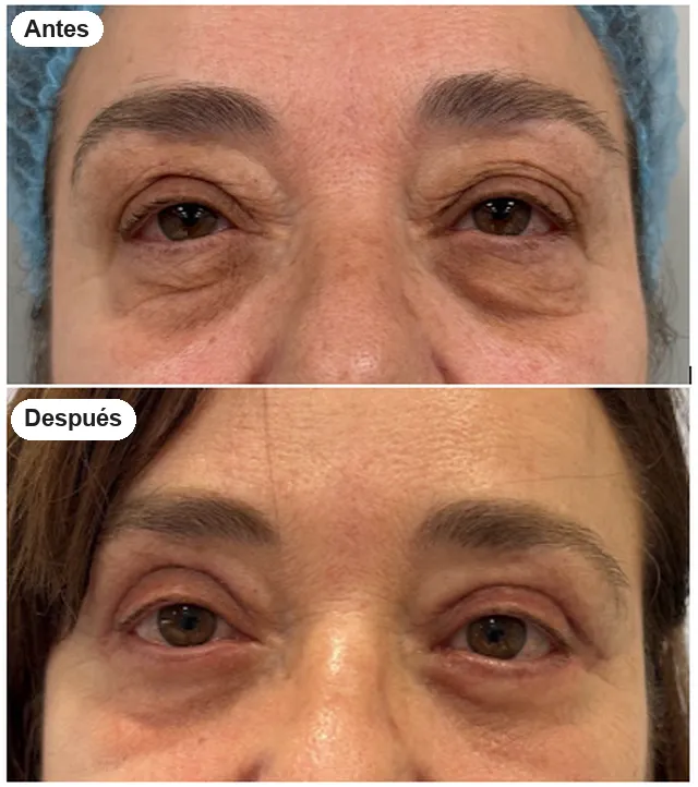 Antes y después de blefaroplastia en Granada, caso 6