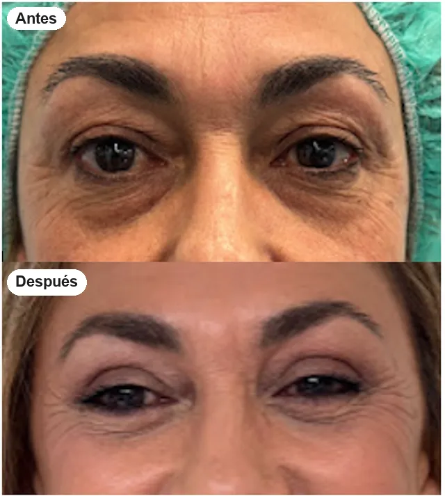 Antes y después de blefaroplastia en Granada, caso 7