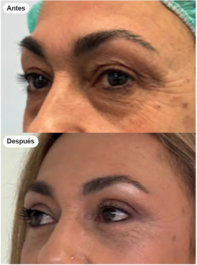 Antes y después de blefaroplastia en Granada, caso 8