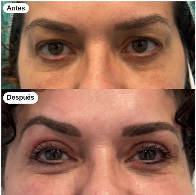 Antes y después de blefaroplastia en Granada, caso 9