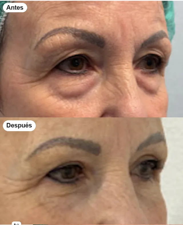 Antes y después de blefaroplastia en Granada, caso 10