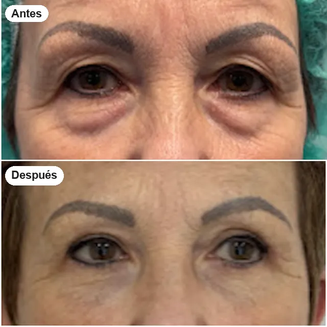 Antes y después de blefaroplastia en Granada, caso 11