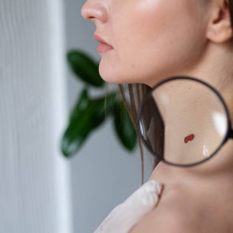 Angiomas - Centro Europeo de Cirugía Estética