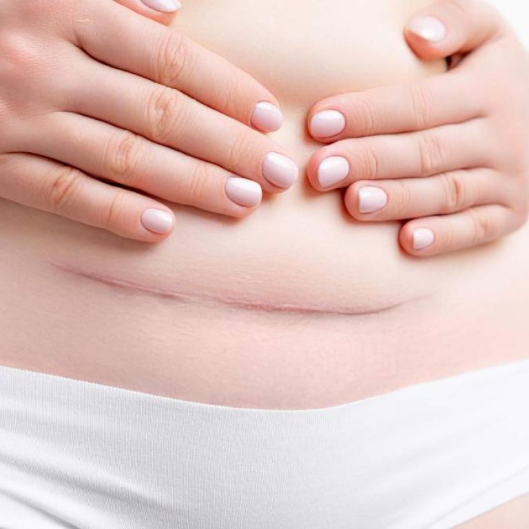 Corrección abdomen postparto y cesárea - Centro Europeo de Cirugía Estética