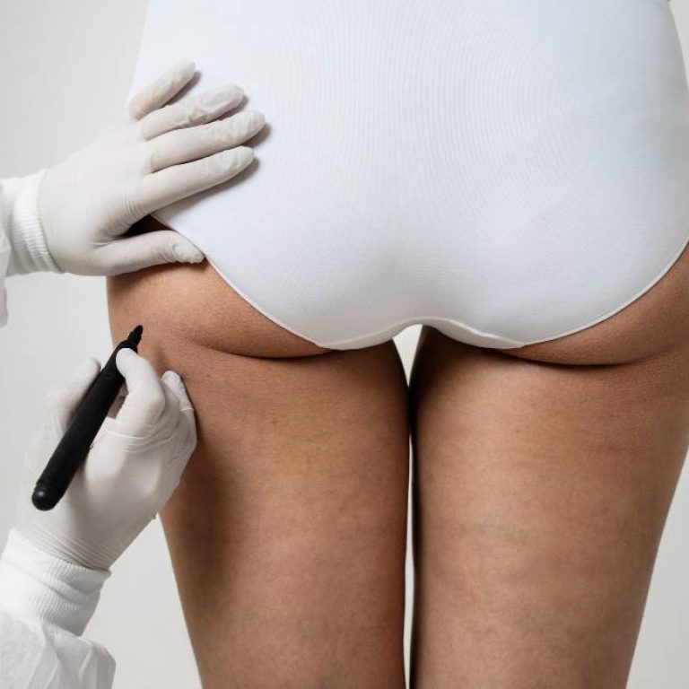 Dudas sobre Renuvion - Centro Europeo de Cirugía Estética