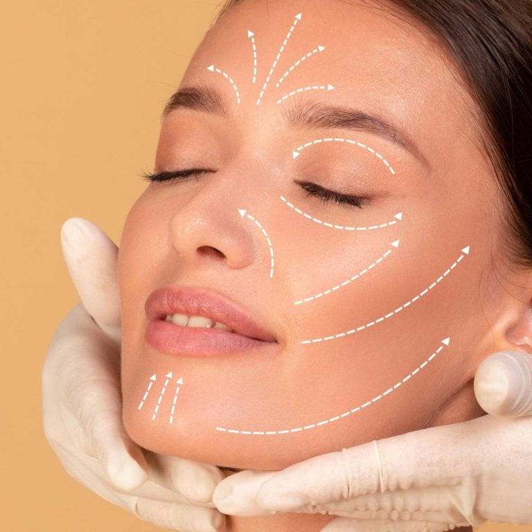 Ya sabes que los hilos tensores, resultan especialmente efectivos ante los primeros síntomas de descolgamiento del óvalo facial. En esos primeros estadios en los que la flacidez aún no es muy acusada, aportan una solución visible, sencilla y mínimamente invasiva. Sobre todo ello ya te habíamos hablado en varios artículos de nuestro blog, aunque en ninguno de ellos nos habíamos centrado en contarte cómo prepararte para someterte a este tratamiento ni qué hacer una vez lo hayas realizado. Es evidente que el equipo del Centro Europeo de Cirugía Estética te comentará estas cuestiones, además de responderte a cualquier duda que pueda surgirte, pero hemos querido hacer este resumen en forma de post para aquellos pacientes que se estén planteando realizar esta técnica estética. Recomendaciones previas a un tratamiento con hilos tensores faciales. Si existe algún motivo por el que este tratamiento no sea el más indicado para ti, nuestro equipo médico te lo habrá hecho saber después de la primera consulta. Pero una vez que el proceso está en marcha, nuestra recomendaciones previas son las siguientes: - Intenta dormir bien la noche anterior y evita la ingesta de: - Medicamentos como la aspirina que suele aumentar el sangrado en cualquier tipo de intervención y, en muchos casos, la aparición de hematomas. - Tabaco, que siempre daña los tejidos y ralentiza su recuperación. - Alcohol que también hace que aumente el sangrado. - Acude a nuestro centro con la cara limpia y sin maquillar: Este tratamiento, como todos los tratamientos faciales, debe realizarse con el rostro limpio y libre de impurezas. Por eso, aunque debes acudir con la cara lavada, te aplicaremos un producto para eliminar cualquier resto de polución u otra sustancia. - Es aconsejable aplicar una crema antihematomas: Aunque estamos ante un tratamiento no invasivo, se trata de una intervención que puede provocar cierta hinchazón y la aparición de hematomas. Utilizar los días previos una crema que contenga Arnika puede ayudar a reducir estos moratones. Consejos posteriores a un tratamiento con hilos tensores faciales. Tras someterte a un tratamiento de rejuvenecimiento facial mediante la colocación de hilos tensores es importante que sigas estas instrucciones para una correcta recuperación y que los objetivos perseguidos se consigan de manera permanente: - No te maquilles ni apliques cosméticos hasta pasados unos días. No olvides que hemos abierto unos pequeños orificios para colocar los hilos tensores y que esos orificios deben cerrarse sin que se infecten. Para ello, tendrás que aplicar una pomada antibiótica y evitar la aplicación de maquillaje o productos similares. - Puedes ingerir antiinflamatorios para reducir las molestias. Quizás notes cierto dolor, nunca muy acusado, además de una sensación rara producto de los hematomas o la hinchazón. Puedes combatir estas molestias posteriores con la ingesta de antiinflamatorios cada 6-8 horas, según te recete nuestro equipo médico. - Evita tocar la zona en la que se han colocado los hilos tensores. No la frotes, ni la rasques y límpiala con un jabón neutro de forma muy suave. También debes secarla con una toalla limpia mediante toques muy suaves. Sigue esta recomendación al menos durante los 8 días posteriores a la intervención estética. - Olvídate de tomar el sol. Por este motivo, estos tratamientos faciales tienden a realizarse en invierno, momento en el que la vida suele ser más hogareña y la incidencia de los rayos solares, menor. Debes evitar que te dé el sol en la zona durante las dos siguientes semanas. - Tampoco debes practicar deportes intensos. Nuestro consejo es que esperes un mes hasta retomar tu actividad deportiva si esta consiste en actividades muy intensas, de contacto, acuáticas… así como saunas o baños turcos. Sí puedes comenzar a practicar ejercicios muy suaves a partir de la segunda semana, pero siempre con mucha moderación. ¿Te estás planteando someterte a un tratamiento de hilos tensores en el rostro? Si notas que tu piel ha perdido firmeza y tu cara está caída y flácida, esta solución puede ser perfecta. Ven a nuestras clínicas de medicina estética en Madrid y Granada y te informaremos.