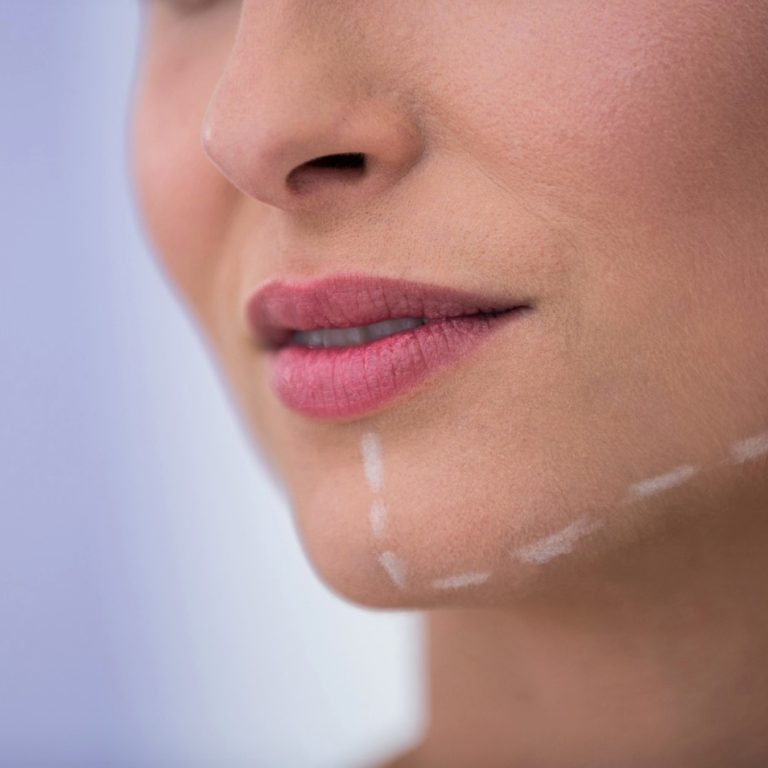 Implantes faciales - Clinica plastica y estetica en madrid