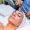 Melasma - Peeling químico - Clínicas de estética en Madrid
