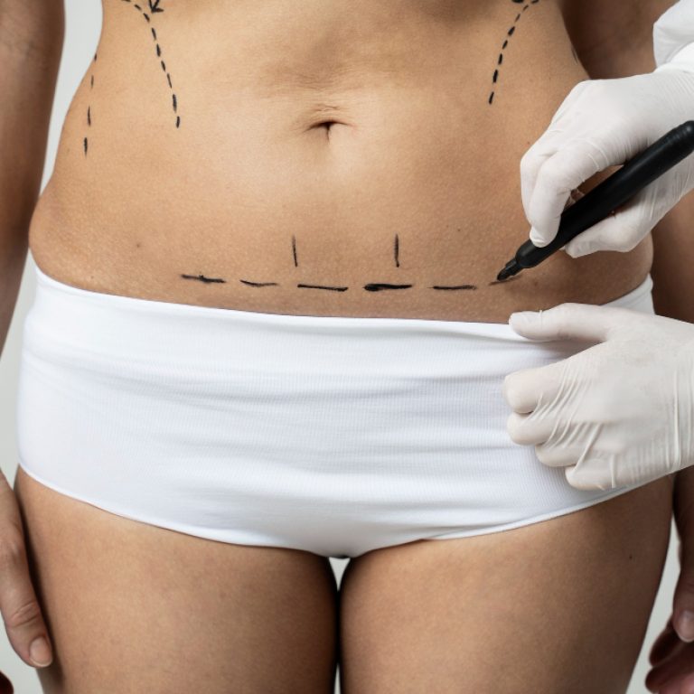 Post 3 - Mayo - Abdominoplastia más beneficios que los estrictamente estéticos