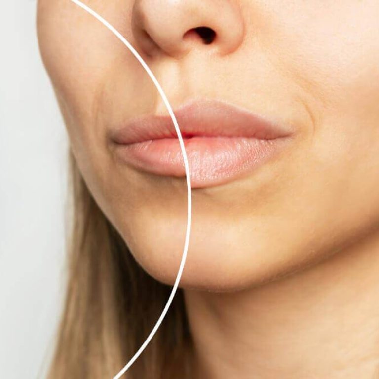 Presencia de biopolímeros - Centro Europeo de Cirugía Estética