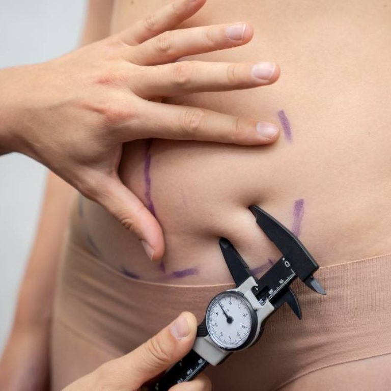 Realizar una Smart Lipo - Centro Europeo de Cirugía Estética