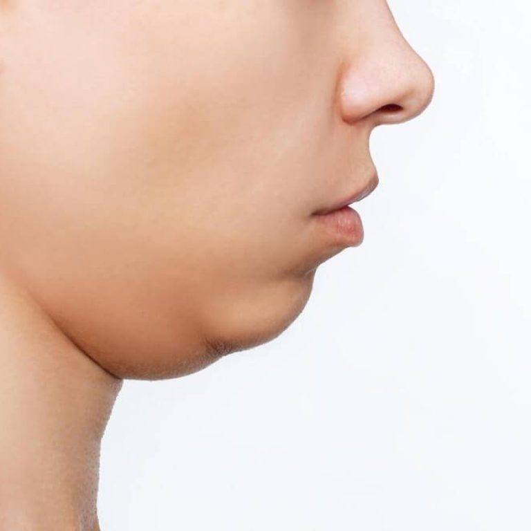 Someterse a una mentoplastia - Centro Europeo de Cirugía Estética