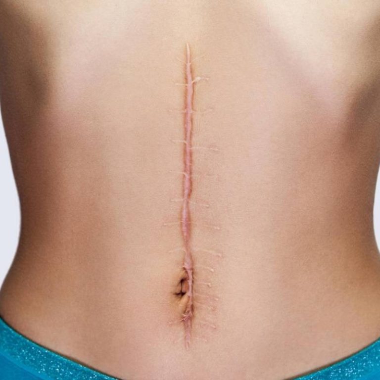 láser Urgo Touch - Centro Europeo de Cirugía Estética